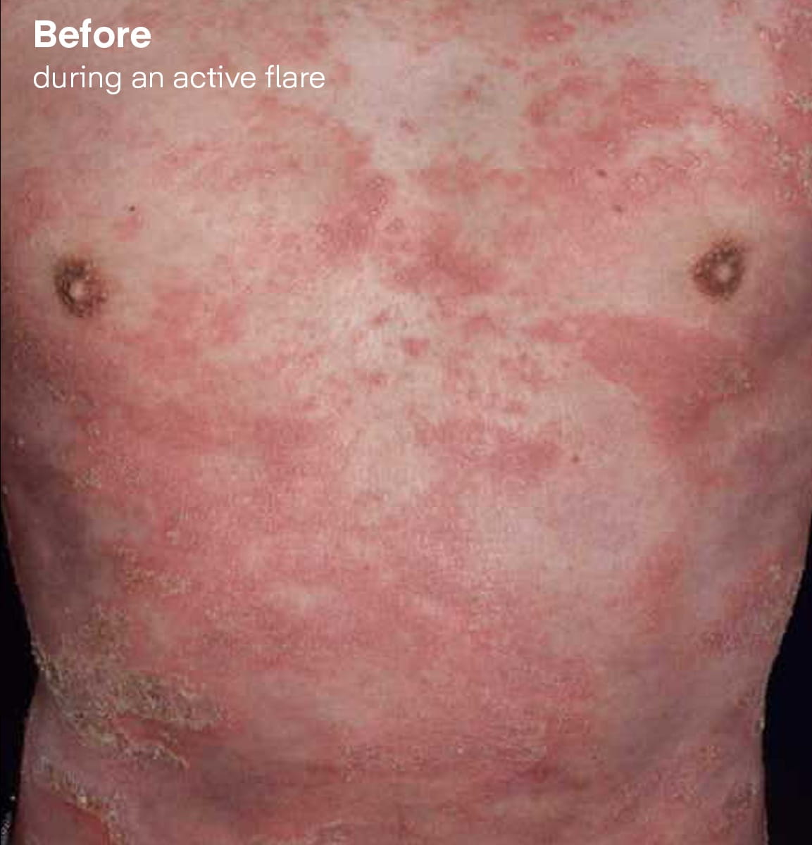 Symptoms before Spevigo during an active flare.