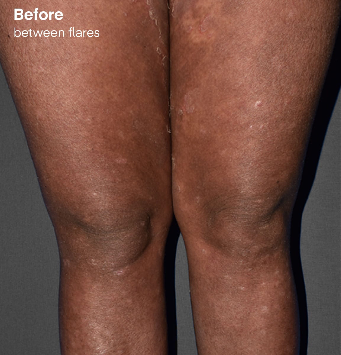 Symptoms before Spevigo, between flares.